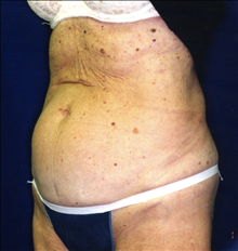 Tummy Tuck Before Photo by Mark Gold, MD; Rancho Bernardo, CA - Case 24262