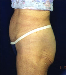 Tummy Tuck After Photo by Mark Gold, MD; Rancho Bernardo, CA - Case 24262