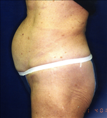 Tummy Tuck Before Photo by Mark Gold, MD; Rancho Bernardo, CA - Case 24262