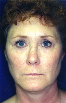 Eyelid Surgery After Photo by Mark Gold, MD; Rancho Bernardo, CA - Case 24265