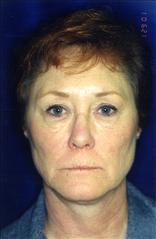Eyelid Surgery Before Photo by Mark Gold, MD; Rancho Bernardo, CA - Case 24265