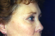 Eyelid Surgery After Photo by Mark Gold, MD; Rancho Bernardo, CA - Case 24265
