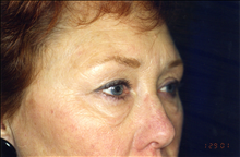 Eyelid Surgery Before Photo by Mark Gold, MD; Rancho Bernardo, CA - Case 24265