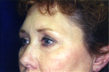 Eyelid Surgery After Photo by Mark Gold, MD; Rancho Bernardo, CA - Case 24265