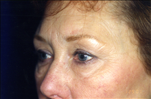 Eyelid Surgery Before Photo by Mark Gold, MD; Rancho Bernardo, CA - Case 24265