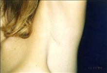 Breast Augmentation After Photo by Mark Gold, MD; Rancho Bernardo, CA - Case 24279