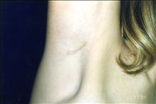 Breast Augmentation Before Photo by Mark Gold, MD; Rancho Bernardo, CA - Case 24279