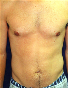 Male Breast Reduction After Photo by Mark Gold, MD; Rancho Bernardo, CA - Case 24287