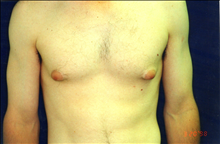 Male Breast Reduction Before Photo by Mark Gold, MD; Rancho Bernardo, CA - Case 24287