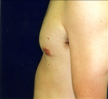 Male Breast Reduction After Photo by Mark Gold, MD; Rancho Bernardo, CA - Case 24287