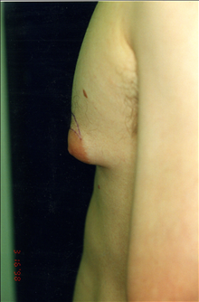 Male Breast Reduction Before Photo by Mark Gold, MD; Rancho Bernardo, CA - Case 24287