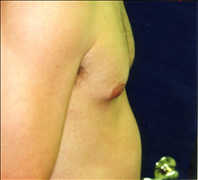 Male Breast Reduction After Photo by Mark Gold, MD; Rancho Bernardo, CA - Case 24287