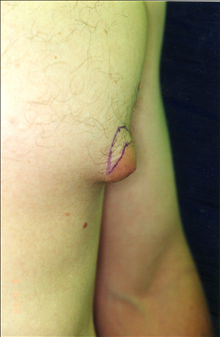 Male Breast Reduction Before Photo by Mark Gold, MD; Rancho Bernardo, CA - Case 24287