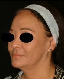 Facelift After Photo by Kevin Dieffenbach, MD; Aiea, HI - Case 10459