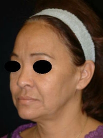 Facelift Before Photo by Kevin Dieffenbach, MD; Aiea, HI - Case 10459