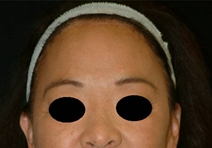 Facelift After Photo by Kevin Dieffenbach, MD; Aiea, HI - Case 10459