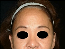 Facelift Before Photo by Kevin Dieffenbach, MD; Aiea, HI - Case 10459