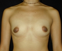 Breast Augmentation Before Photo by Kevin Dieffenbach, MD; Aiea, HI - Case 10467