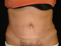 Tummy Tuck After Photo by Kevin Dieffenbach, MD; Aiea, HI - Case 21105