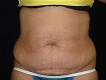 Tummy Tuck Before Photo by Kevin Dieffenbach, MD; Aiea, HI - Case 21105