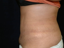 Tummy Tuck After Photo by Kevin Dieffenbach, MD; Aiea, HI - Case 21105