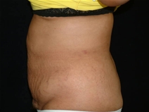 Tummy Tuck Before Photo by Kevin Dieffenbach, MD; Aiea, HI - Case 21105