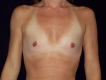 Breast Augmentation Before Photo by Kevin Dieffenbach, MD; Aiea, HI - Case 21344