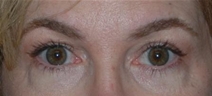 Eyelid Surgery After Photo by Ronald Lohner, MD; Bryn Mawr, PA - Case 10363