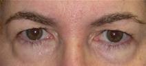 Eyelid Surgery Before Photo by Ronald Lohner, MD; Bryn Mawr, PA - Case 10363