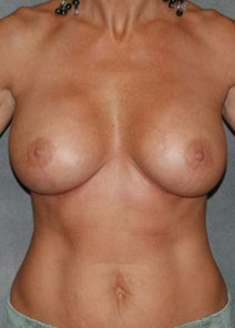 Breast Augmentation After Photo by Ronald Lohner, MD; Bryn Mawr, PA - Case 10445