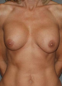 Breast Augmentation Before Photo by Ronald Lohner, MD; Bryn Mawr, PA - Case 10445