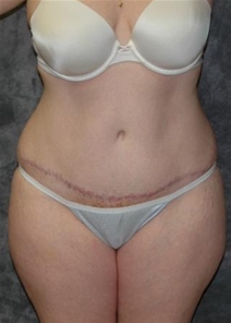 Tummy Tuck After Photo by Ronald Lohner, MD; Bryn Mawr, PA - Case 20483