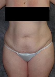 Tummy Tuck Before Photo by Ronald Lohner, MD; Bryn Mawr, PA - Case 20483