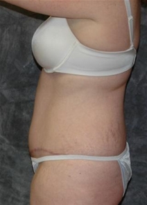 Tummy Tuck After Photo by Ronald Lohner, MD; Bryn Mawr, PA - Case 20483