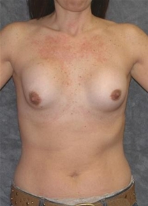 Breast Augmentation Before Photo by Ronald Lohner, MD; Bryn Mawr, PA - Case 20485