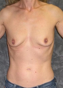 Breast Augmentation Before Photo by Ronald Lohner, MD; Bryn Mawr, PA - Case 20813