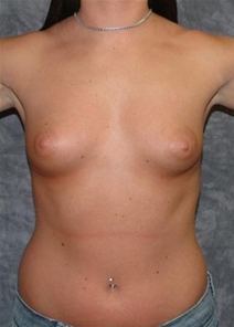 Breast Augmentation Before Photo by Ronald Lohner, MD; Bryn Mawr, PA - Case 21084