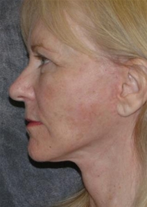 Facelift After Photo by Ronald Lohner, MD; Bryn Mawr, PA - Case 21208