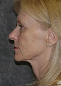 Facelift Before Photo by Ronald Lohner, MD; Bryn Mawr, PA - Case 21208
