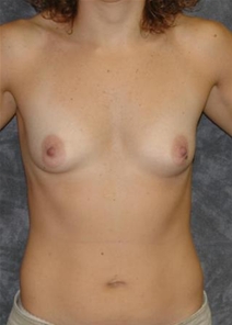 Breast Augmentation Before Photo by Ronald Lohner, MD; Bryn Mawr, PA - Case 22292