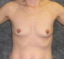 Breast Augmentation Before Photo by Ronald Lohner, MD; Bryn Mawr, PA - Case 9032
