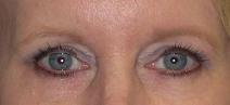 Eyelid Surgery After Photo by Ronald Lohner, MD; Bryn Mawr, PA - Case 9046