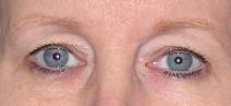Eyelid Surgery Before Photo by Ronald Lohner, MD; Bryn Mawr, PA - Case 9046