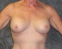 Breast Augmentation After Photo by Ronald Lohner, MD; Bryn Mawr, PA - Case 9047
