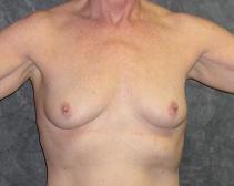 Breast Augmentation Before Photo by Ronald Lohner, MD; Bryn Mawr, PA - Case 9047