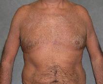 Male Breast Reduction After Photo by Ronald Lohner, MD; Bryn Mawr, PA - Case 9059