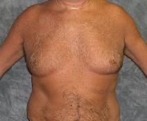Male Breast Reduction Before Photo by Ronald Lohner, MD; Bryn Mawr, PA - Case 9059