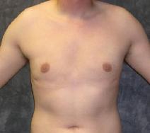 Male Breast Reduction After Photo by Ronald Lohner, MD; Bryn Mawr, PA - Case 9060