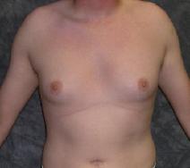 Male Breast Reduction Before Photo by Ronald Lohner, MD; Bryn Mawr, PA - Case 9060