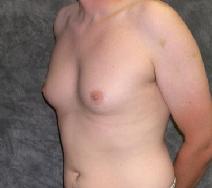Male Breast Reduction Before Photo by Ronald Lohner, MD; Bryn Mawr, PA - Case 9060